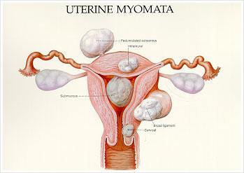 Fibroids